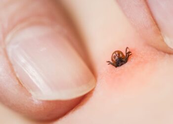 Lyme Disease Uncovered: Spot the Signs, Seek the Right Care